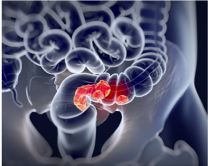 colorectal